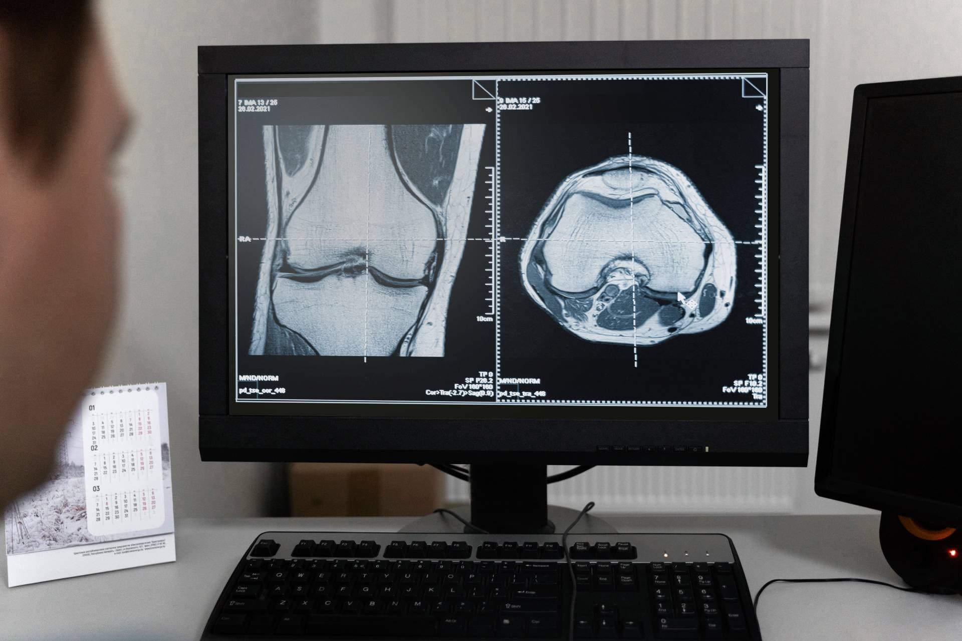 A knee MRI displayed on a clinical monitor